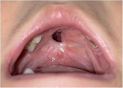 Evaluation of the effect of a resorbable membrane on the closure of palatal fistulas